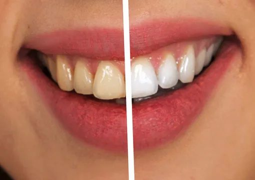 Igiene Dentale e Sbiancamento Estetico